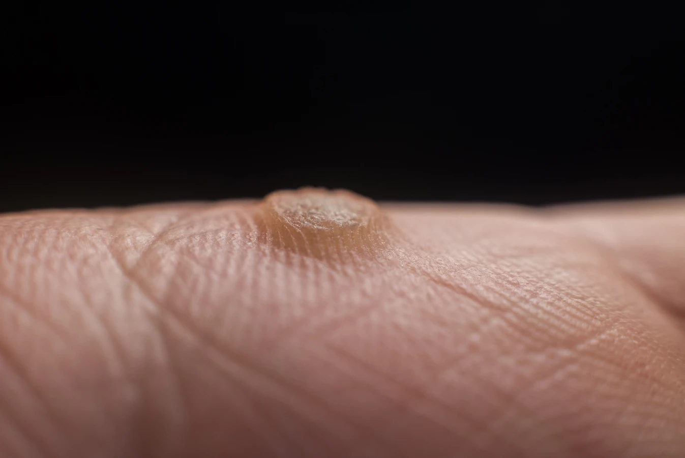 Czy kurzajki w ciąży są groźne?