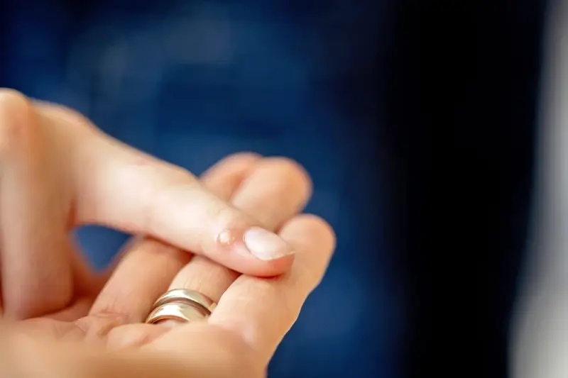 Jak zlikwidować kurzajki?